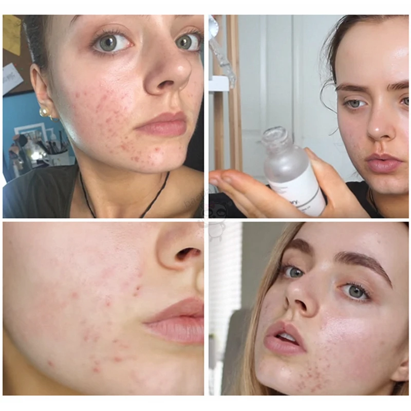 Обычный никотинамид 10% + Цинк 1% высокое минеральное эссенция регулирует