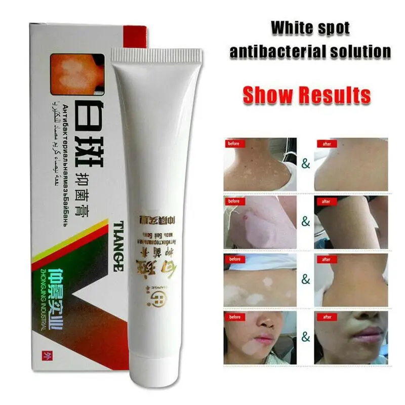 New White Spot Disease Cream Pigment Melanin Promoting Liniment Skin Vitiligo Leukoplakia care Treatment | Красота и здоровье