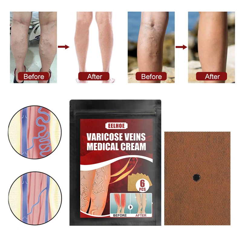 Пластырь для лечения варикозного расширения вен 6 шт./пакет | Красота и здоровье