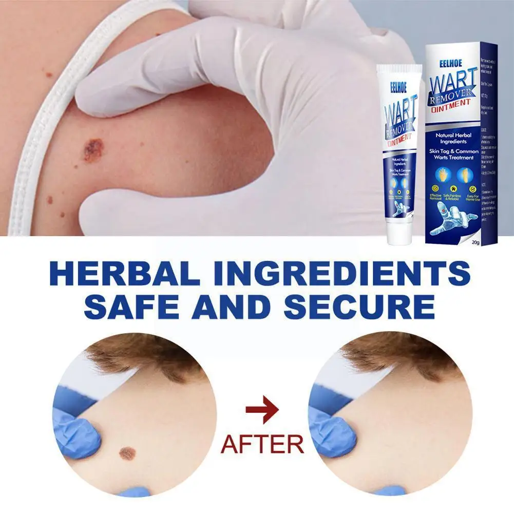 

1pcs 20g Instant Blemish Removal Gel Wart Removal Body Treatment Care Cream Foot Warts Cream Tag Skin Cream Remover Wart B0x9