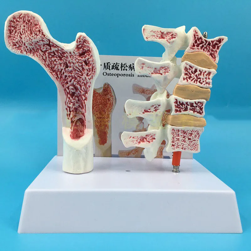 

2 parts PVC Human Anatomical Model Osteoporosis Femur Leg Bone Spinal Section Specimen Diseased Lumbar Spine