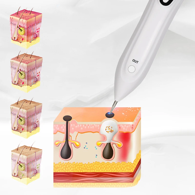 

Laser Skin Tag Remover Age Spot Pen Mole Wart Freckle Tattoo Removal Machine
