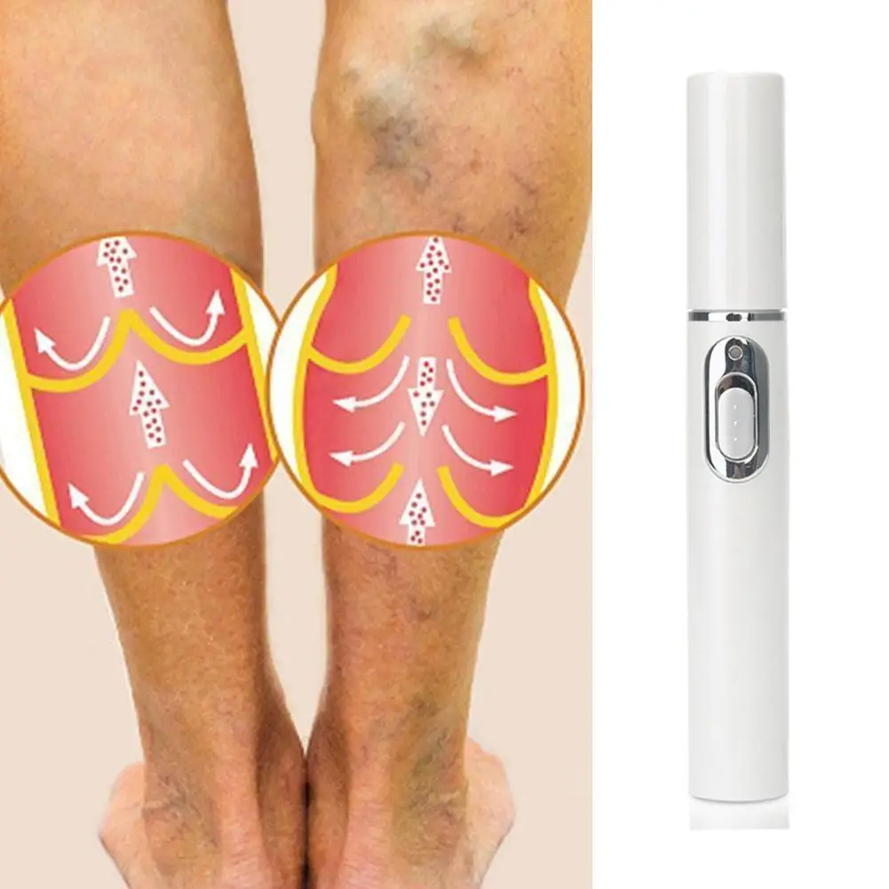 

Heath Blue Light Therapy Varicose Veins Treatment Pen Scar Removal Treatment Acne Relax Soft Massage Pen J9O3