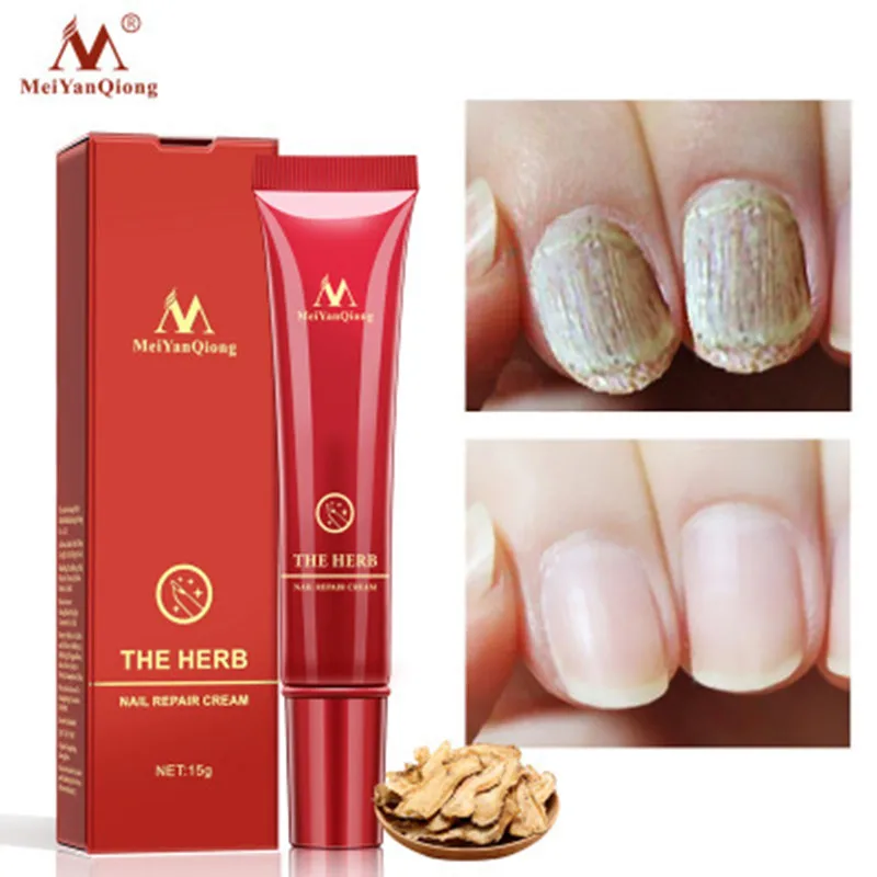 

MeiYanQiong Herbal Nail Repair Cream Treatment Onychomycosis Paronychia Anti Fungal Nail Infection Fungus Removal Cream Toe Car