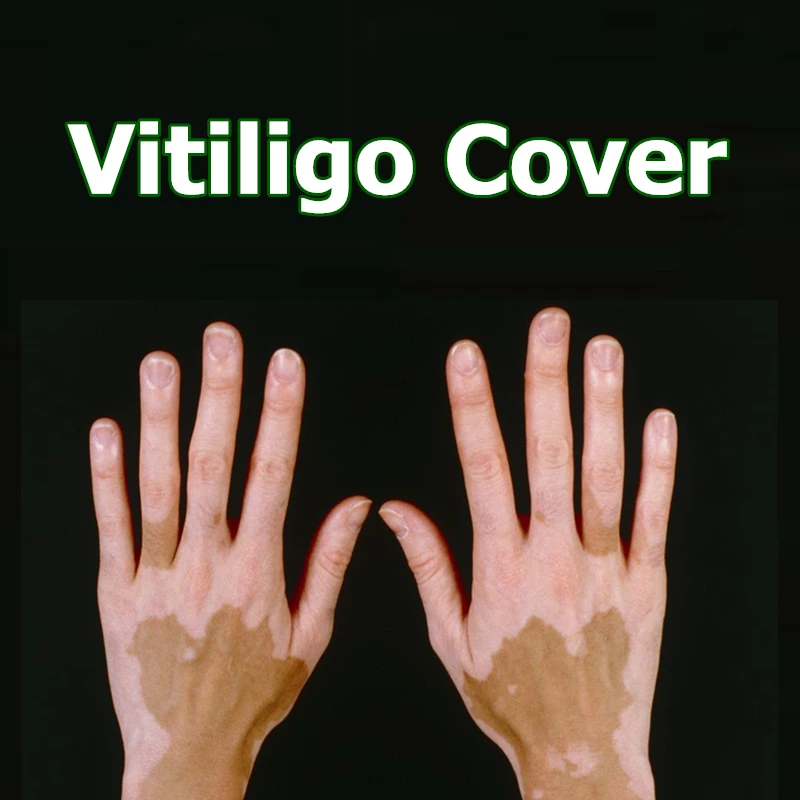 Чехол vitilgo патчи водонепроницаемый мгновенный кожи Leucoderma макияж покрытие консилер ручка на лицо руки тела для женщин мужчин детей 1 шт