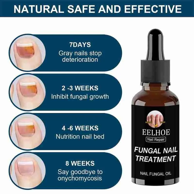 

30ml Fast Fungal Nail Treatments Serum Anti-Fungal Paronychia Foot Onychomycosis Toe Nail Fungus Herb Sensitive Essences Re L9T3