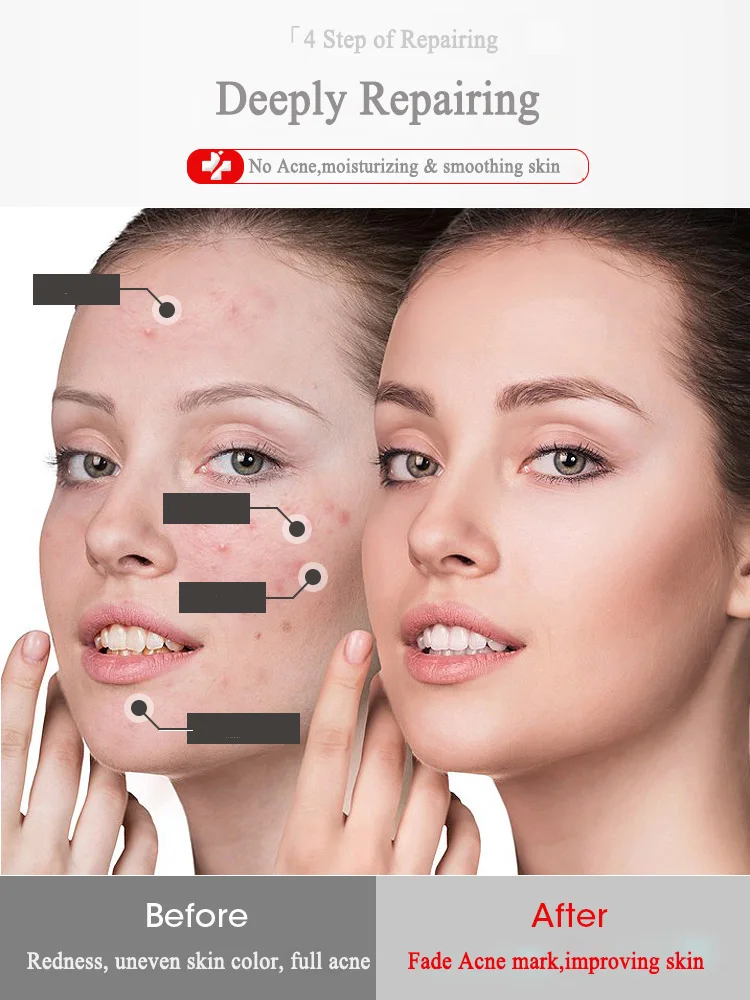 1 Набор = 5 пар лиофилизированный порошок + Пластмассовый раствор Сыворотка для