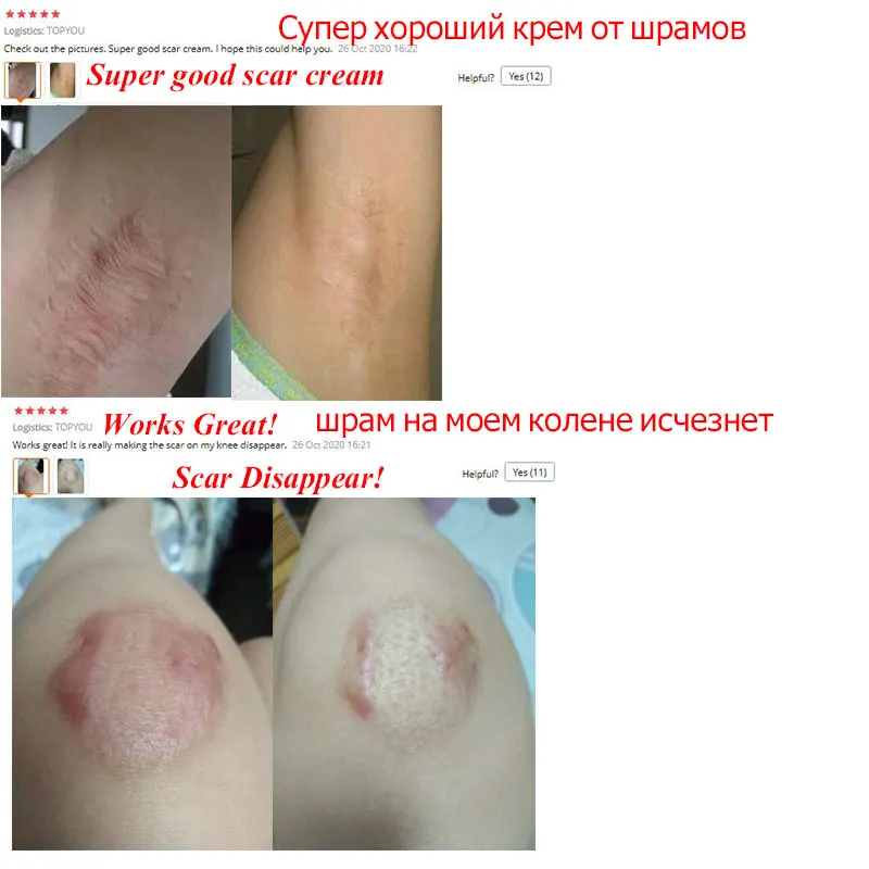 Крем для удаления шрамов от акне гель лица прыщи растяжки крем восстанавливающий