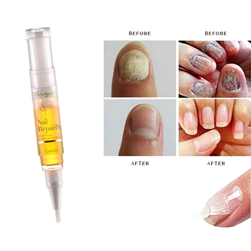 

5ml Nail Fungal Treatment Pen Anti Fungus Infection Repair Solution Restores Oil
