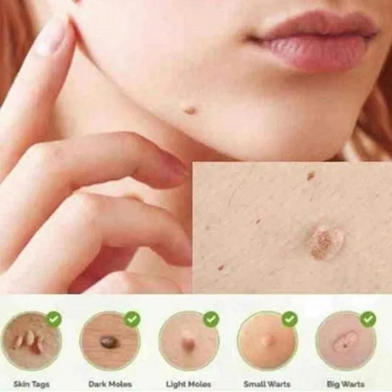 3 Days Skin Tag Genital Wart Remover Pen Herbal Extract Serum Mole Foot Corn Warts Treatment Removal | Красота и здоровье