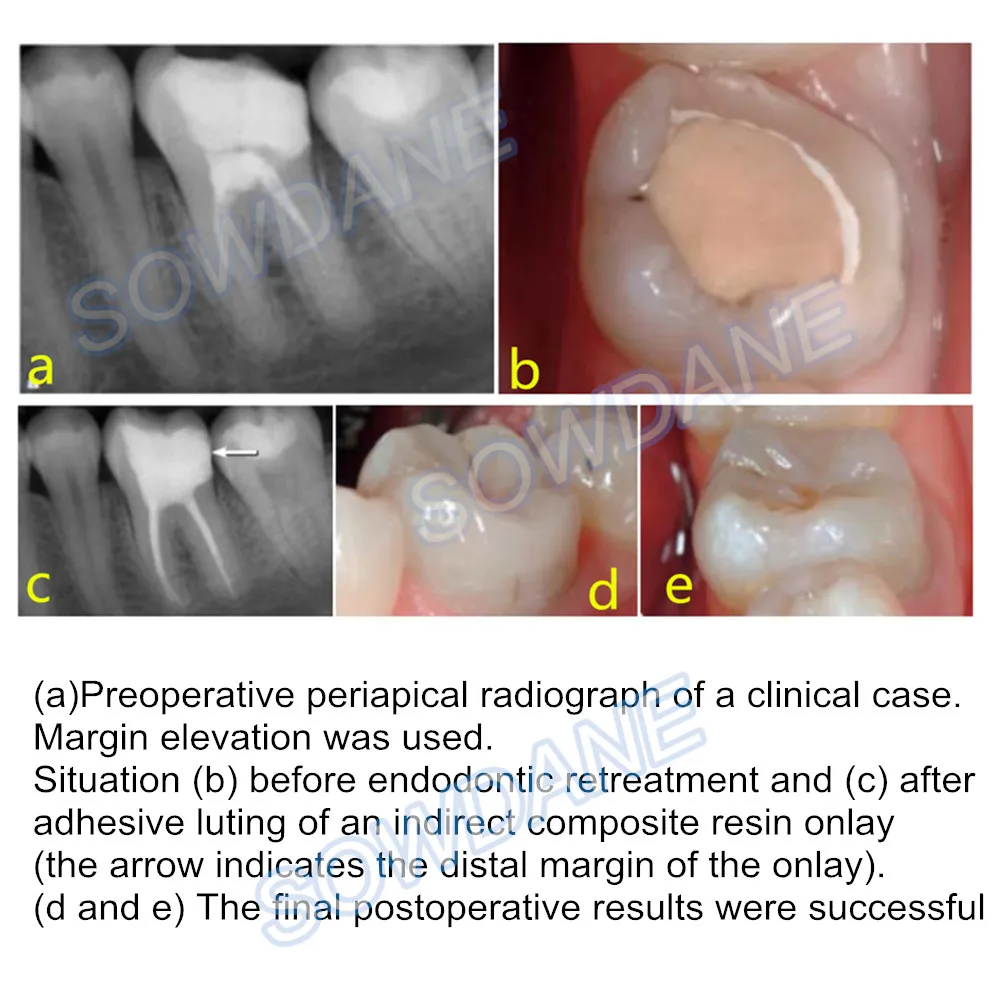 Стоматологическая Матрица для глубокой маржи большие кривизны фиксатор