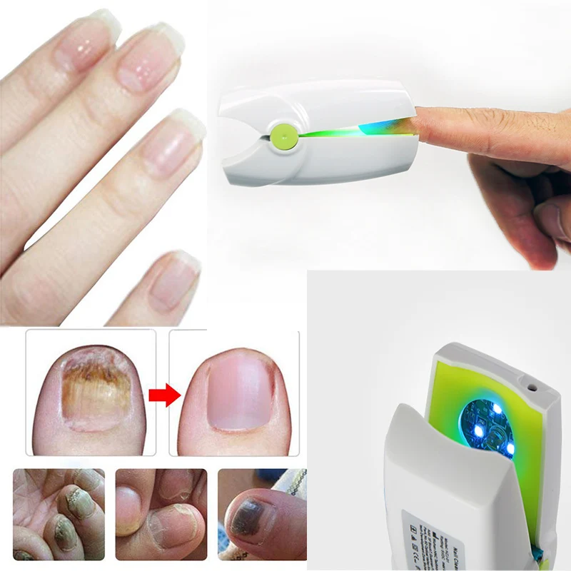 

Портативный лазер для ногтей холодный лазер для лечения грибковых инфекций ногтей серый лазер для ногтей устройство для лечения грибов ногтей