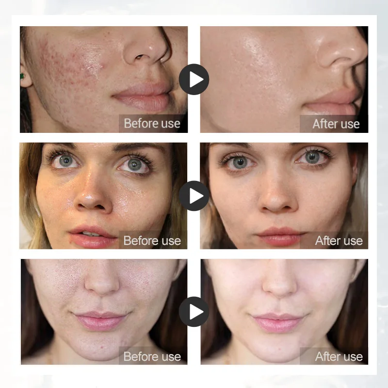 Daralis 100 г Удаление прыщей поры акне шелк фиброин мыло маска для лица козье молоко