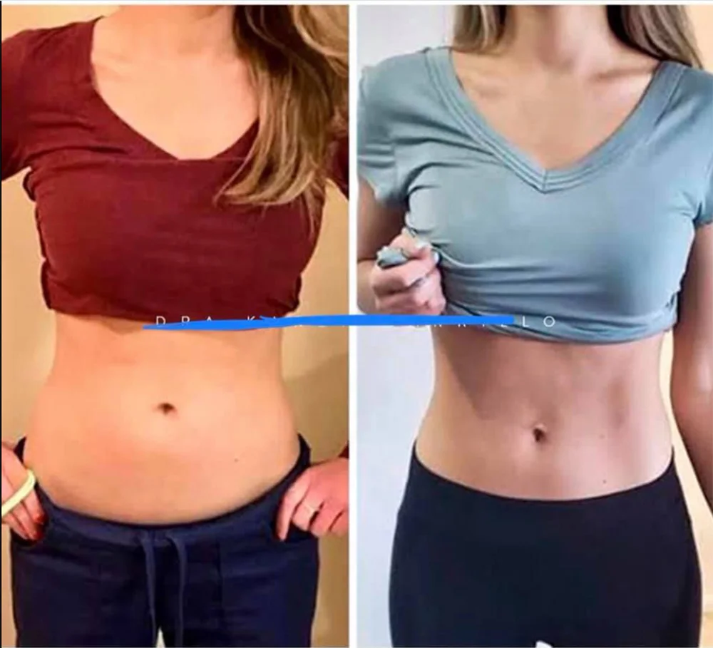 Аппарат для сжигания жира потери веса 4 ручки радиочастотный нагрев Emslim Neo |