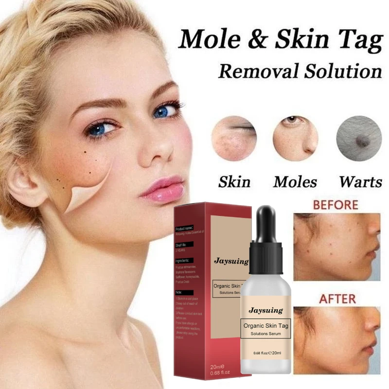 

20ml 10ml Organic Tags Solutions Serum Painless Mole Skin Dark Spot Removal Serum Face Wart Tag Freckle Removal Cream Oil