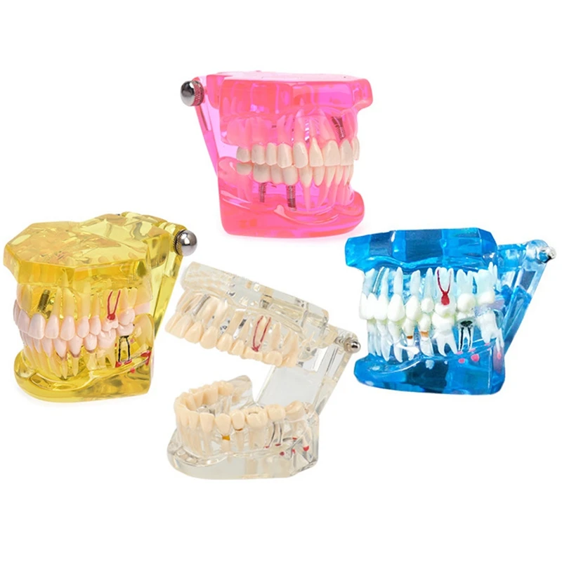 

Имплантат, модель зубов с реставрационным мостом, стоматолог для обучения заболеваниям