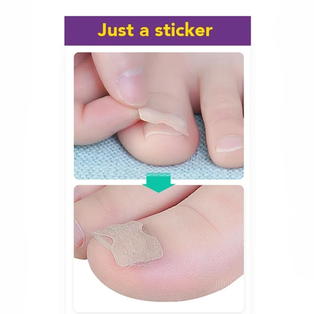 5pcs Glue Free Ingrown Toenail Patch Set Correction Pedicure Tools Inlay Nail Corrector Stickers Foot Care |