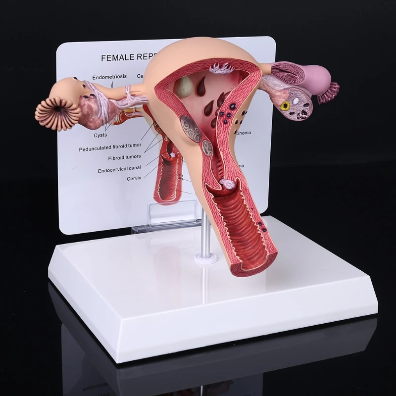 

Human Female Uterus Ovary Disease Dissection Pathology Model Biology Teaching