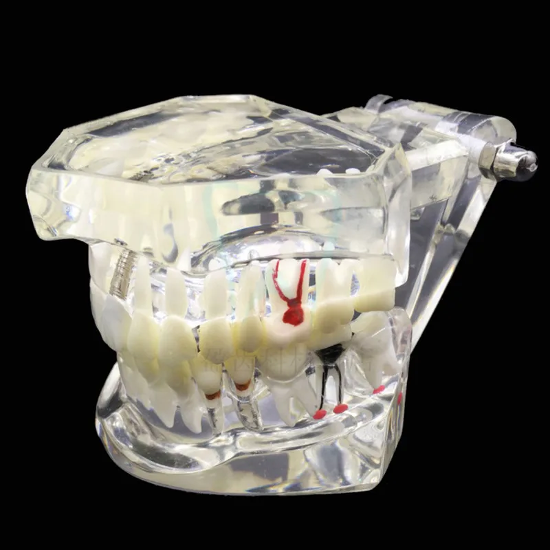 Модель зубная прозрачная для восстановления зубов модель внедрения заболеваний