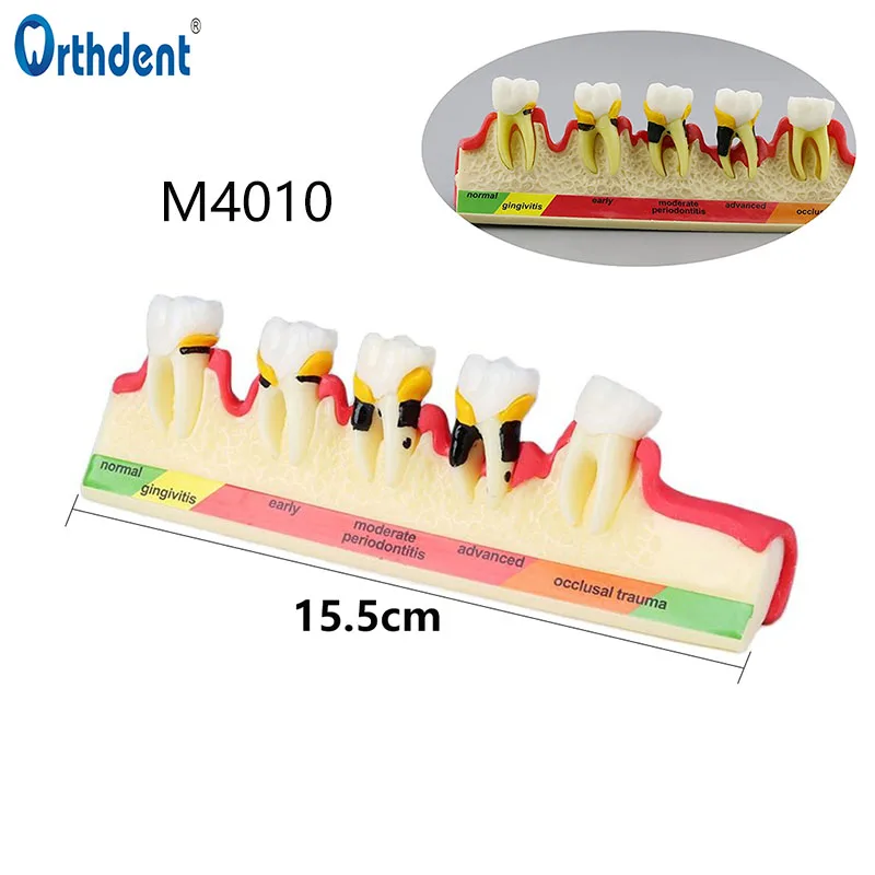

Dental Lab Teeth Model 5-Stage Periodontal Tooth Disease Dentoform Studying Pathological Typodont Assort 4010 Teaching Tools