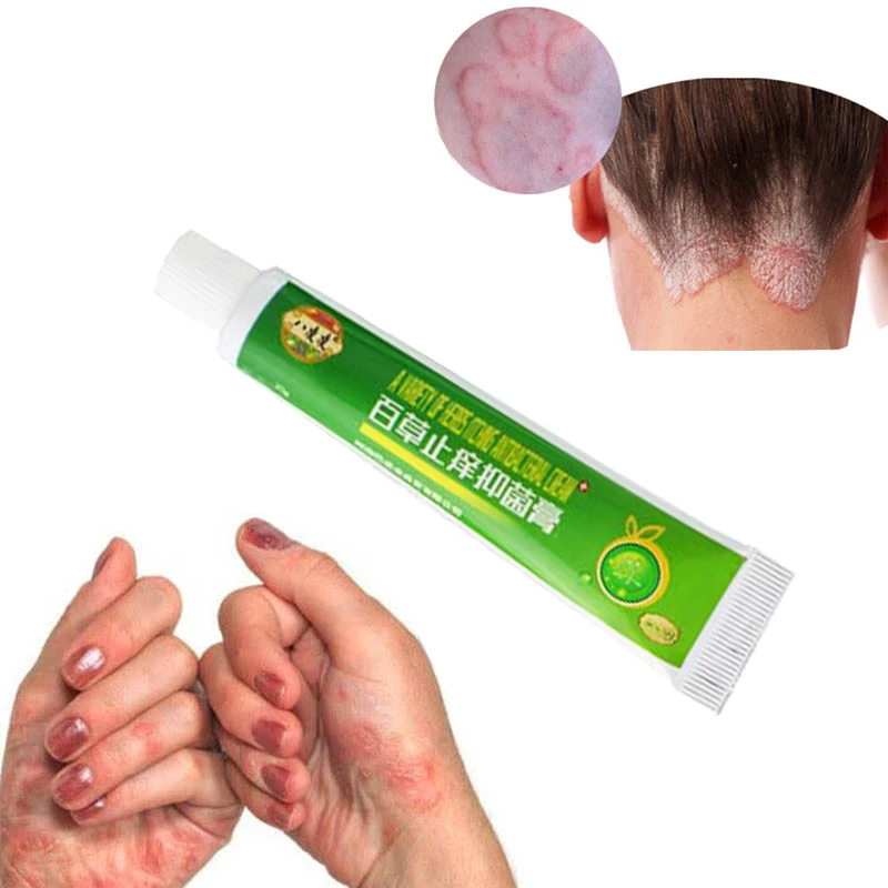 100% оригинальный крем от псориаза Антибактериальный противозудный дерматит