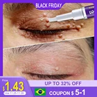 Удаление Палом жидкости для удаления удара, удаление удара жидкостью для удаления удара папилоломы мы удаление