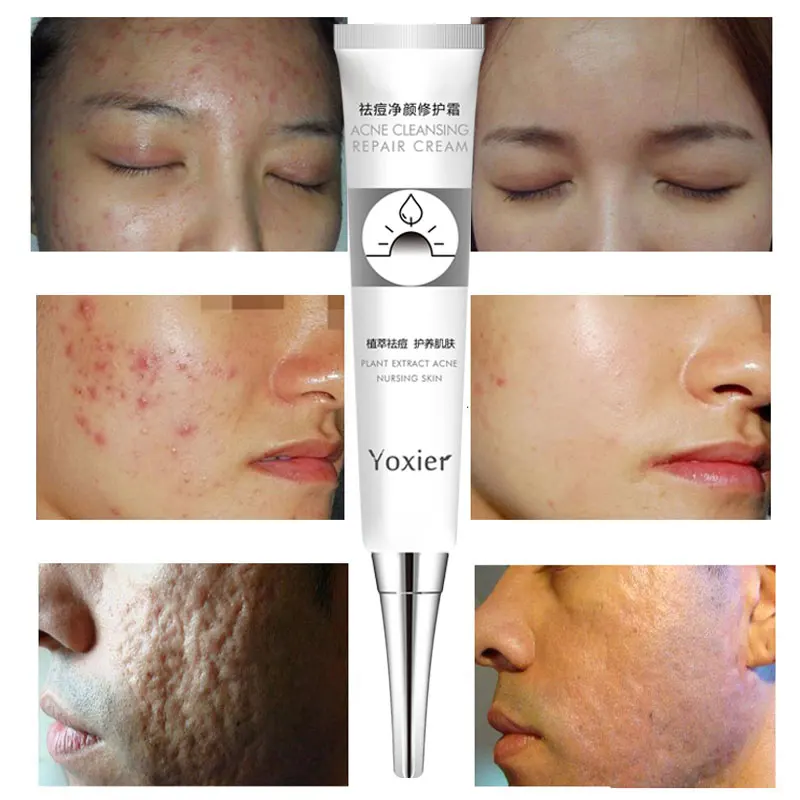 Крем для удаления прыщей регенерирующий крем угрей Fade акне Знаки контроль