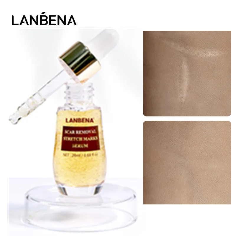 

Lanbena Scar Remove Serum Stretch Marks Remover Fade Scar Melanin Acne Treatment Burn Surgical Treatment Skin Care Whitening