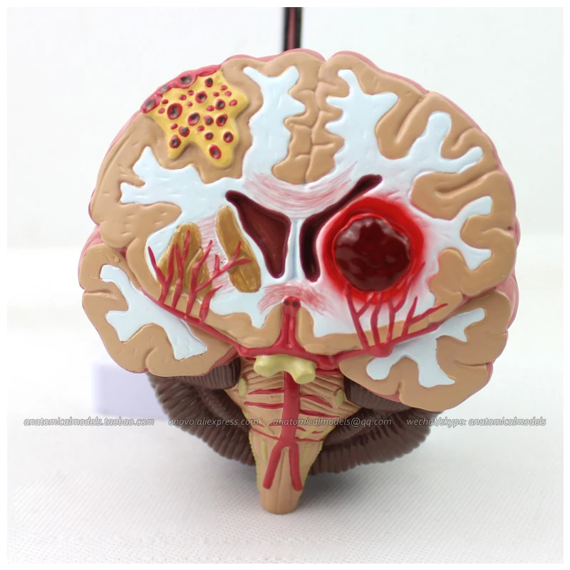 

12408 / Human Anatomy Disease of the Brain Teach Model, Medical Science Educational Teaching Anatomical Models