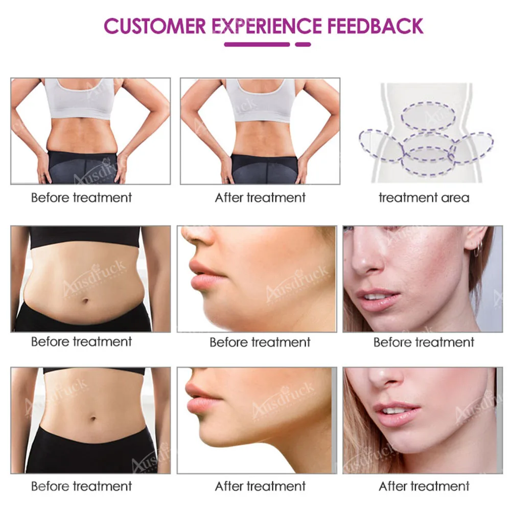 

2020 Hot Selling cryoskin fat freeze cryotherapy 360 degree freezing ultrasonic cavitation lipo laser cryo at home salon machine