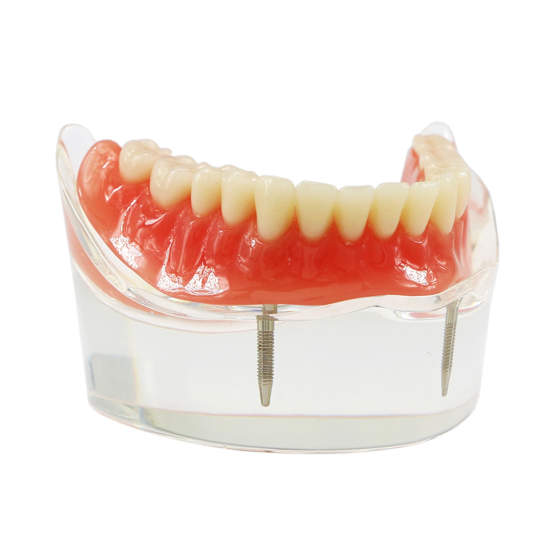 

Dental Model Study Teach Overdenture Inferior With 4 Implant Demo Lower 6002 02