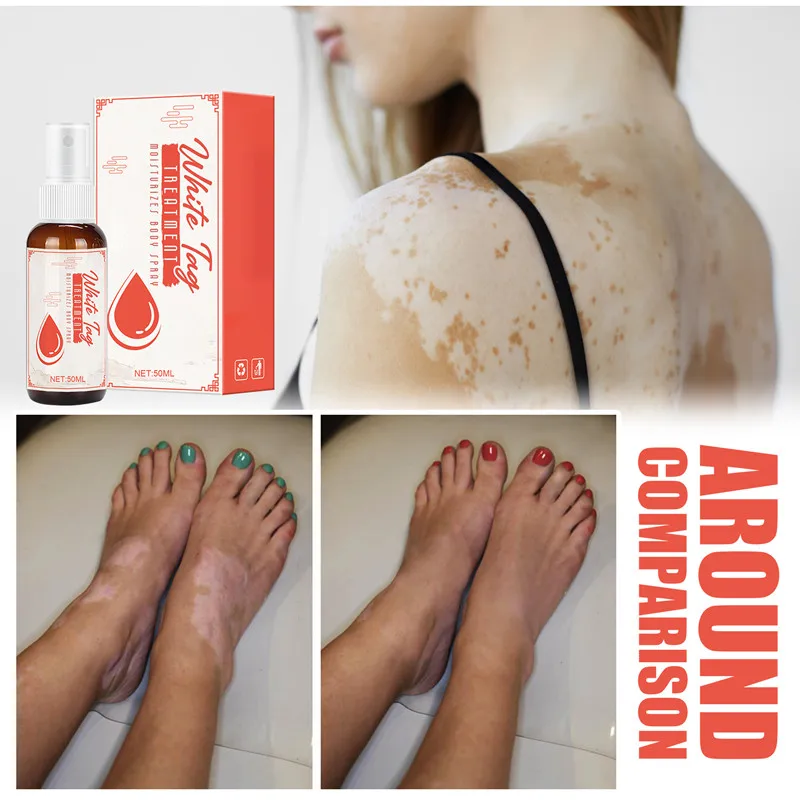 

Китайский традиционный лечебный мазь для Vitiligo, средство для лечения псориаза с белыми пятнами, спрей для микоза, лейкоплакии