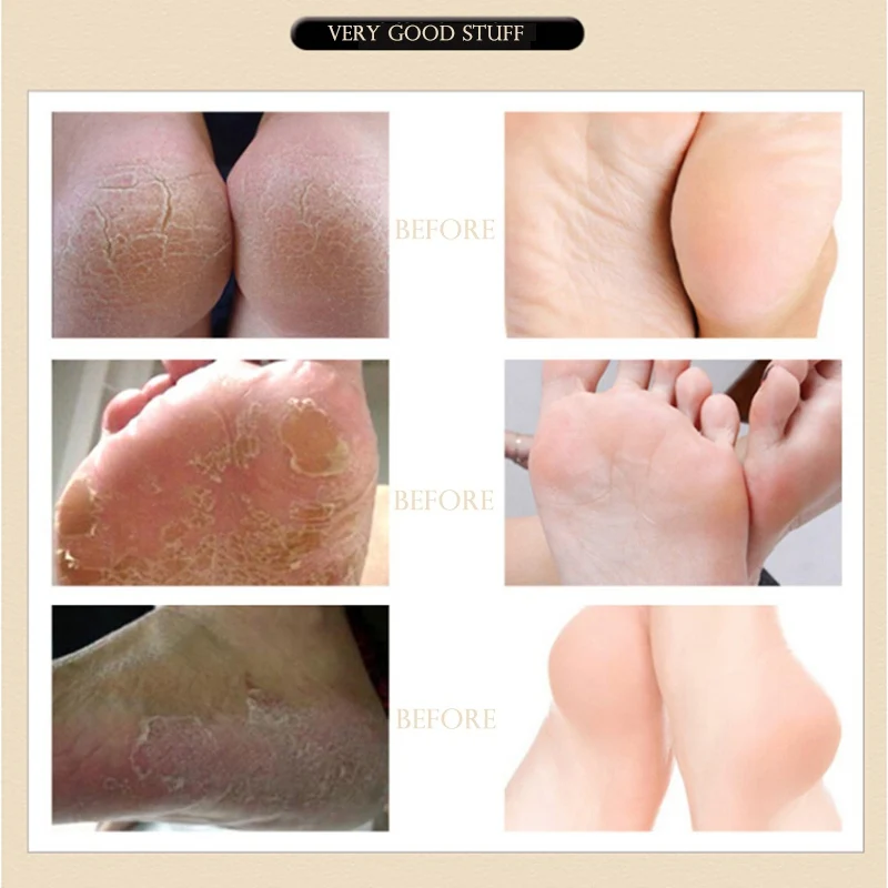Чистый натуральный травяной антисушивающий крем для трещины ног эффективный