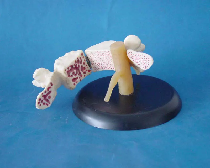 

Life Size Osteoporosis Heath and Morbid State Bone Compare Models Human Spinal Bone Human Spine Pathology Model Humans Skeleton