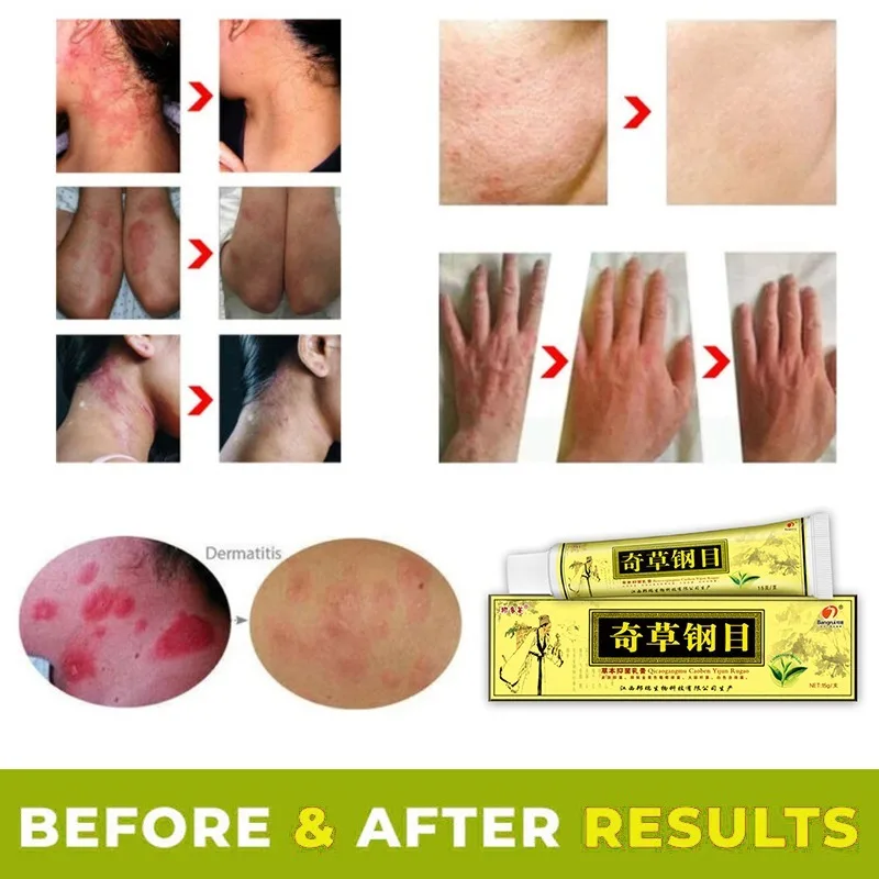 

Skin Psoriasis Cream Dermatitis Eczematoid Eczema Ointment Treatment Psoriasis Scaly Plaque Psoriasi Cream