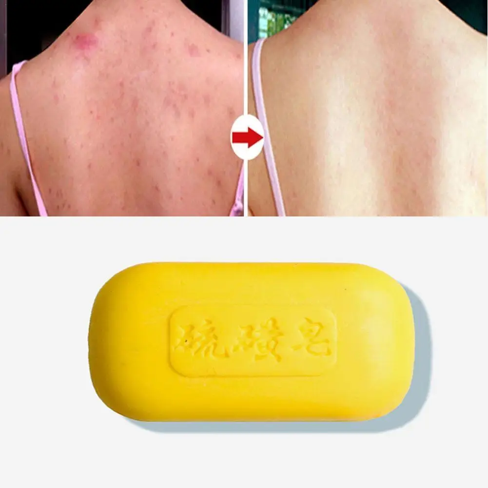 

Sulfur Soap For Men And Women To Remove Oil Clean Face Wash Hands Wash Back Bath Soap Soap Sulfur Soap Borte Sea Salt