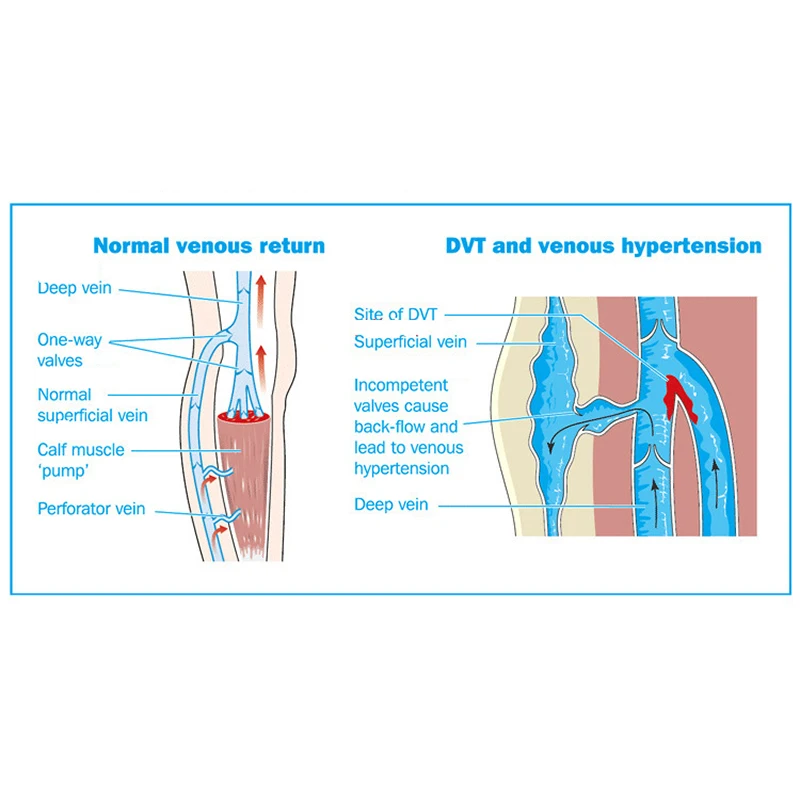 Защитные чулки Brothock для ног тонкие компрессионные лечения варикозного