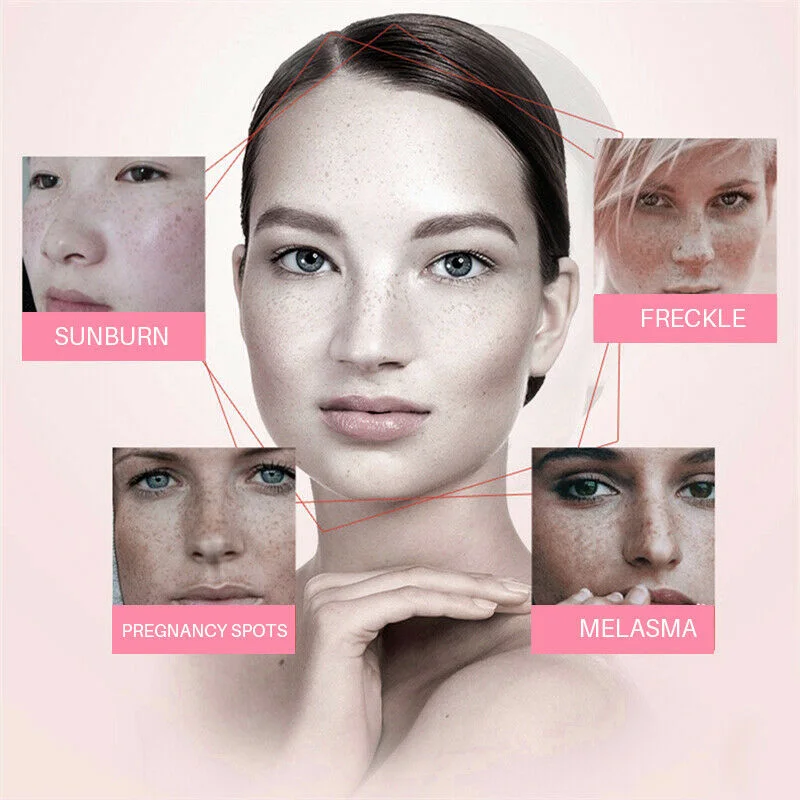 

Skin Whitening Cream Freckle Cream Remove Melasma Acne Dark Pigment Spots Melanin Pimple Face Care M88