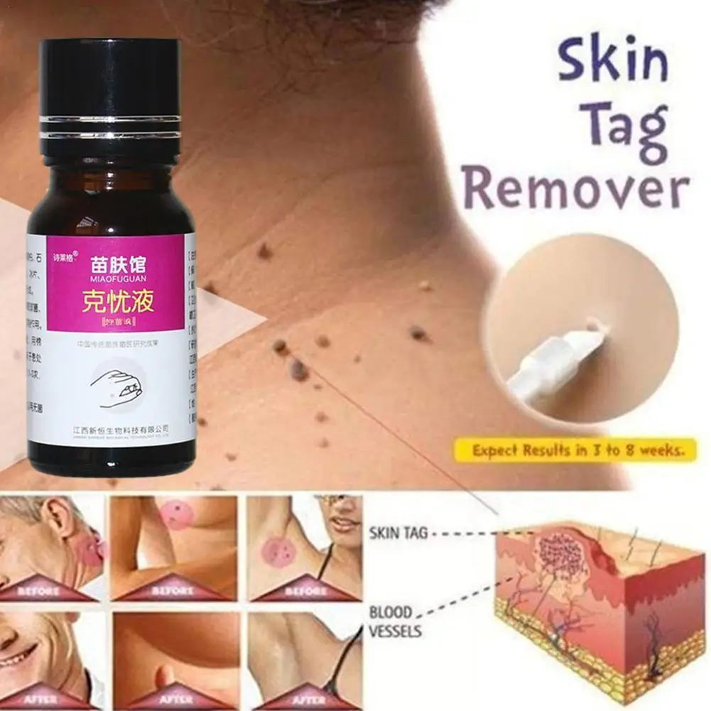 

10ml Genital Wart Treatment Papillomas Removal Of Warts Liquid From Skin Tags Removing Against Moles Remover Anti Verruca