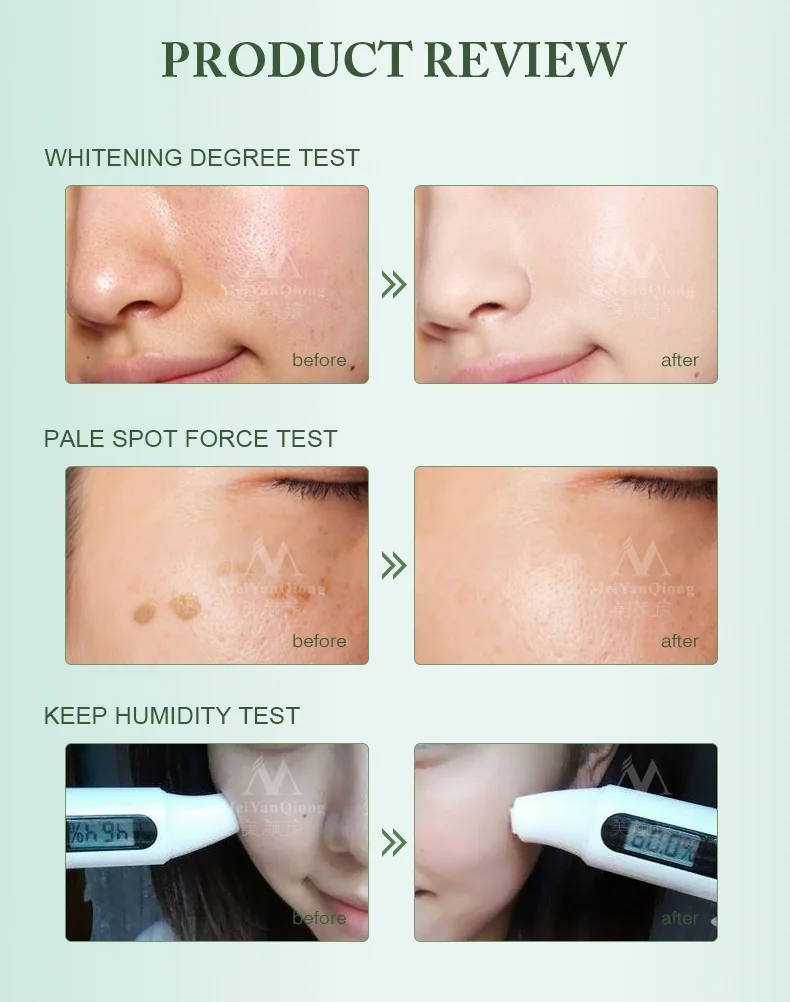 Сильное влияние отбеливающем креме 40 г удалить мелазмы от черных точек прыщей