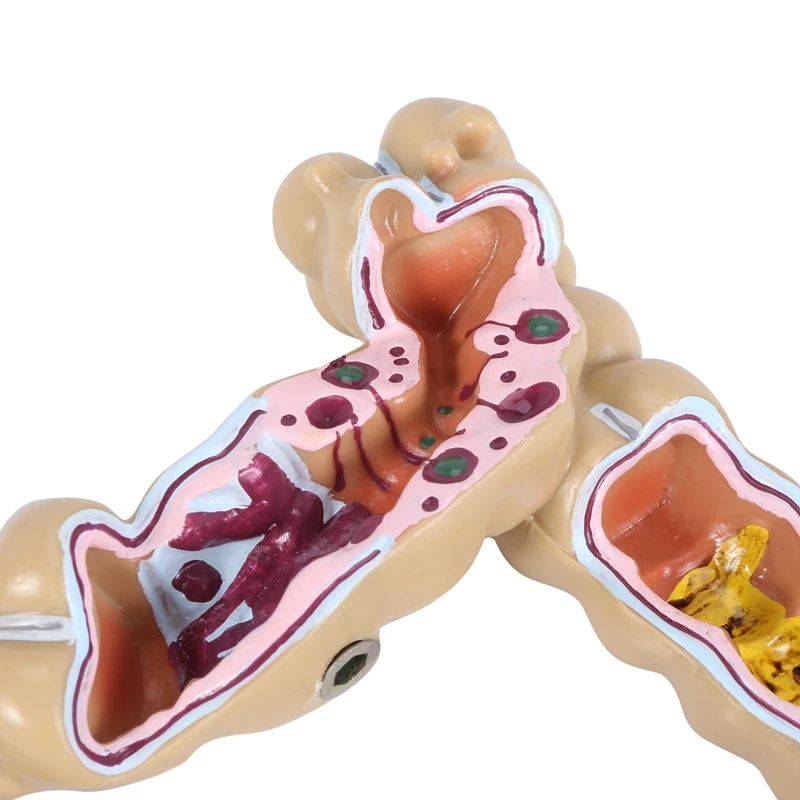 

Colorectal Lesion Model Human Colon Large Intestine Pathological Diseases Model Mrganizer Anatomy