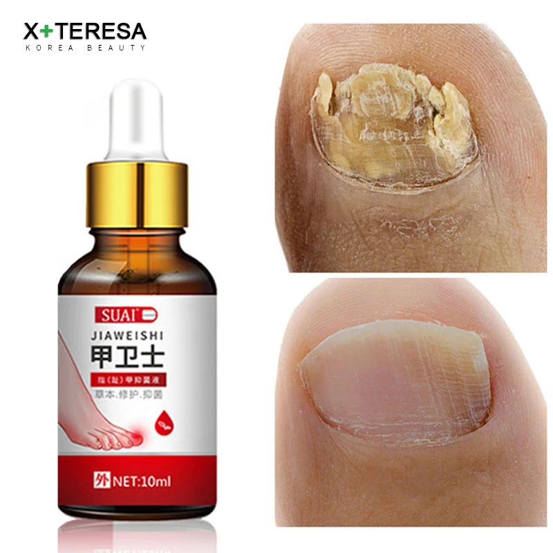 Сыворотка для лечения Ногтей от грибка Уход за ногами эссенция удаления ногтей