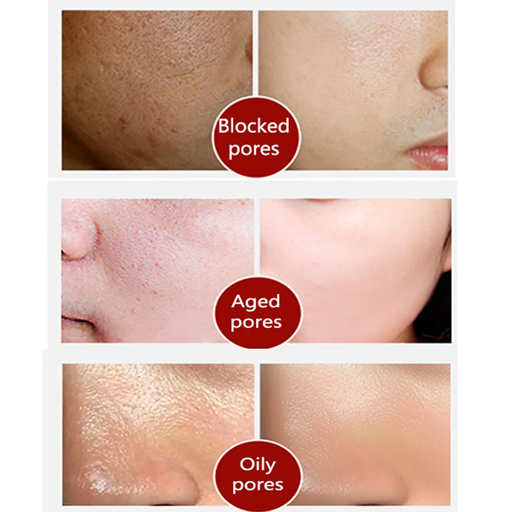 LANBENA усадка пор жидкое удаление черных лечение сывороточная эссенция глубокое