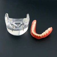dental overdenture inferior with 2 implants demo model study model