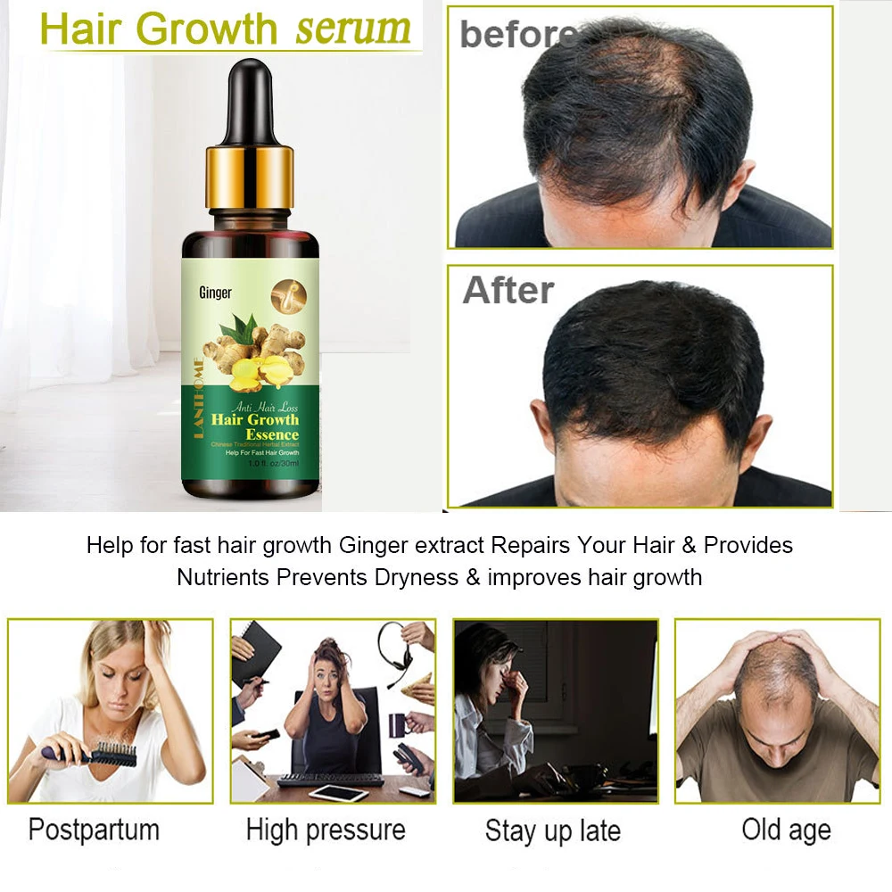 

30Ml Essential Ginger Oils For Hair Growth Prevent Hair Loss Hair Follicle Treatment Make Hair Grow Fast Bushy Thickening Fluid