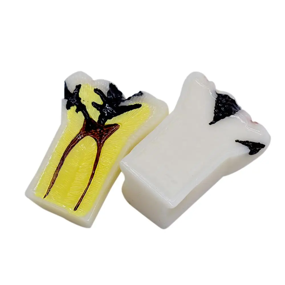 Модель для обучения стоматологии общение пациента модель кариеса разложения