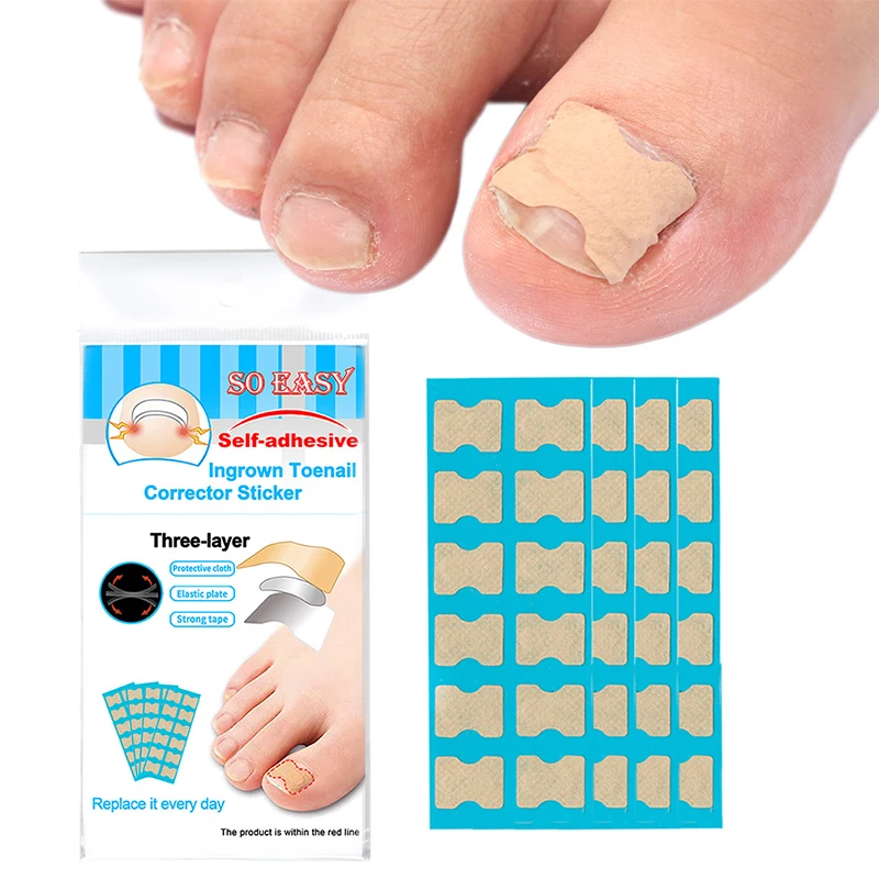 

Toenails Patch Paronychia Cure Physical Straightening Pad Relief Pain Nail Tool Toenail Groove Sticker Nail Corrector Ingrown