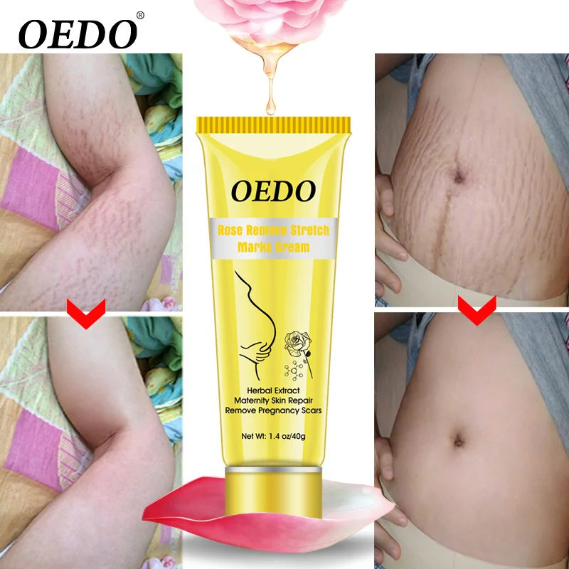 

Remove Stretch Mark Body Cream Remove Obesity Mark Rose Nourishing Moisturizing Anti-wrinkle Pregnant Women Skin Repair Care 40g