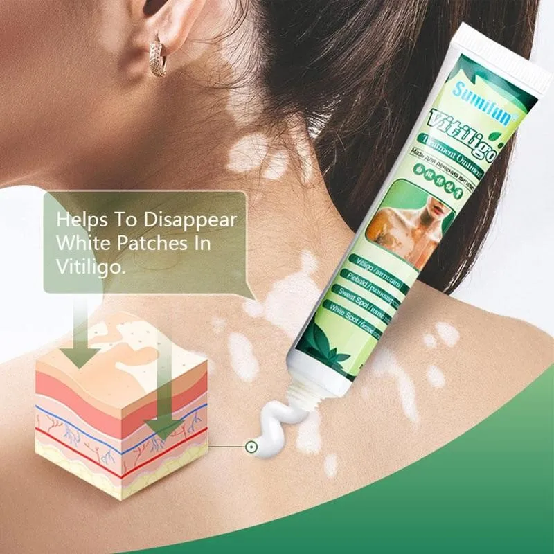 

20g VitiligoTreament Cream Antibacterial Cream Psoriasis Localized Vitiligo Ointment White Spot Mycosis Leukoplakia Treat Cream
