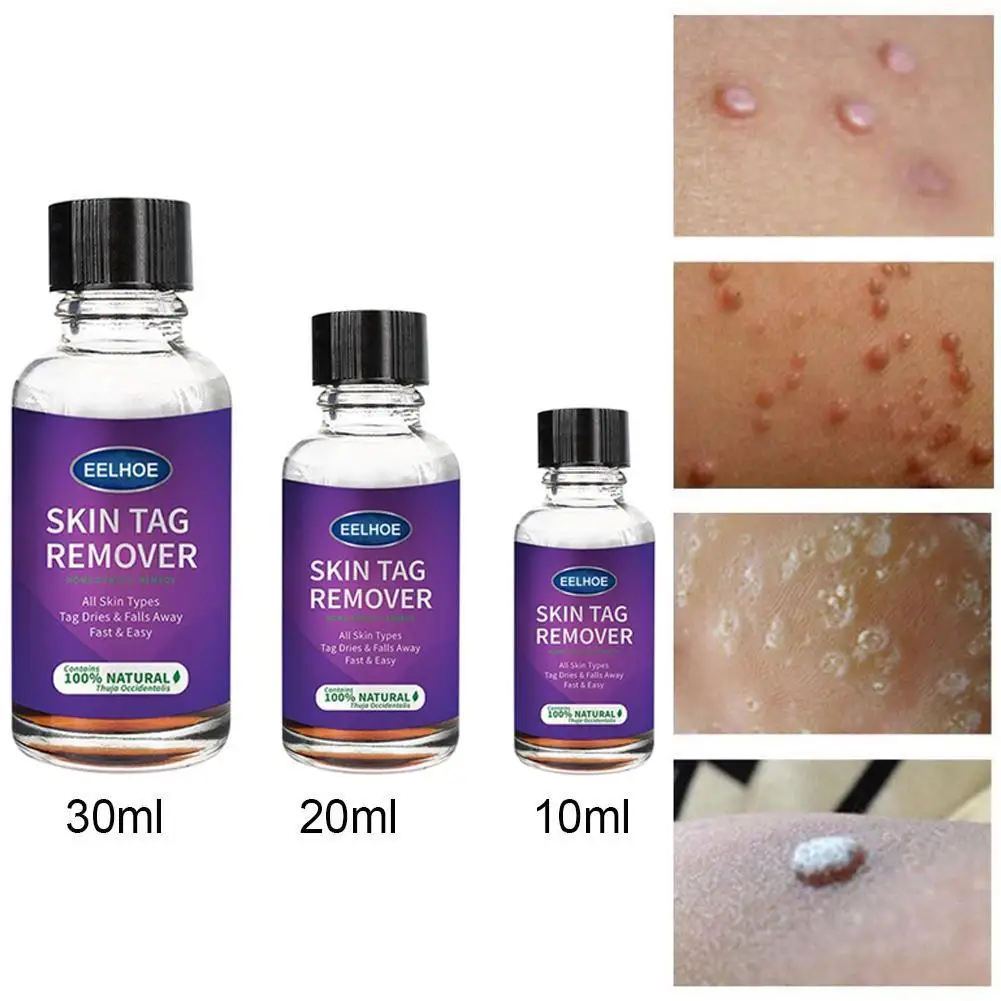 

Remover Warts Removal Relief Medical Treatment Meat Wart Corn Liquid Flat Cream Calluses Skin Skin Foot Care Antibacterial X1H4